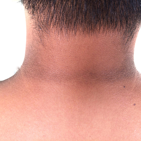 Black Neck: Causes, Symptoms And Home Remedies