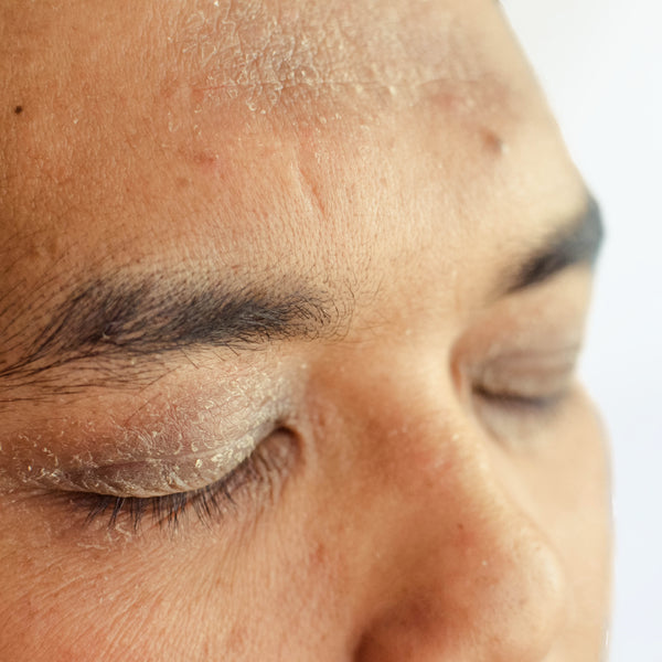 Get Rid of Dry Skin Around Eyes: Best Home Remedies