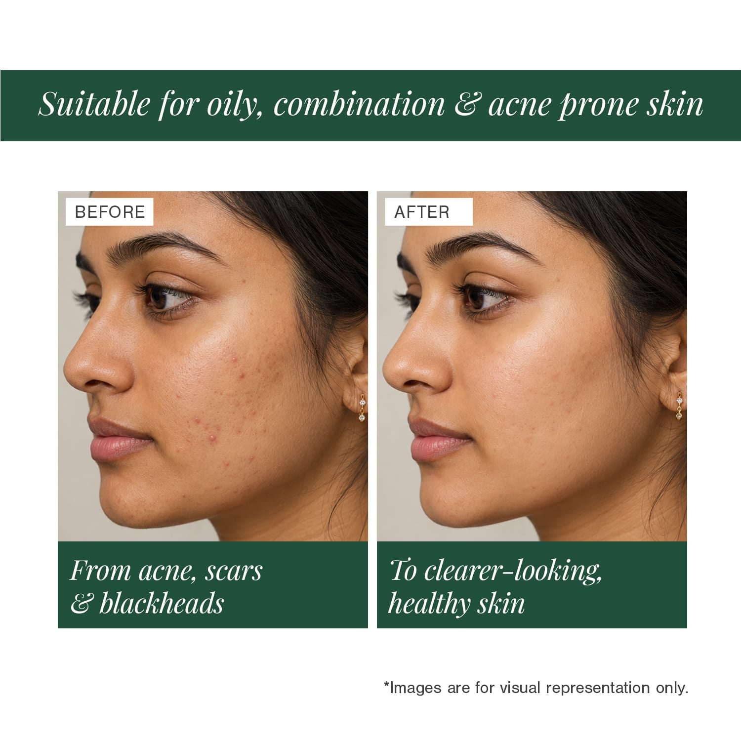 Certified Organic Acne & Pimples Control Face Wash Fortified with Hemp + Tea Tree