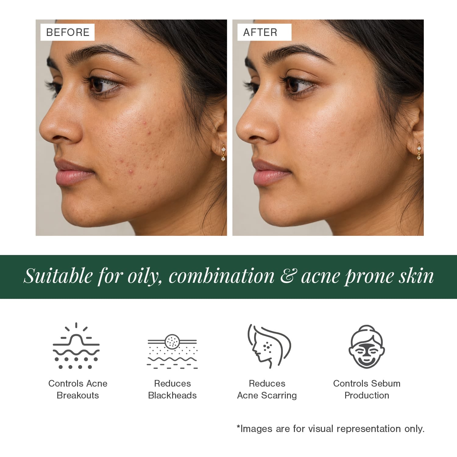 Certified Organic Acne & Pimples Control Face Wash Fortified with Hemp + Tea Tree