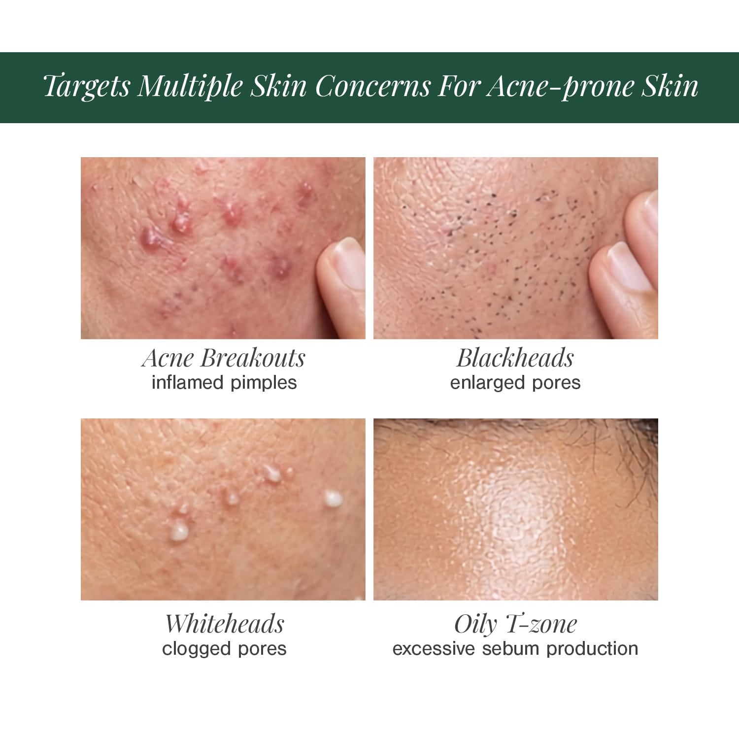 Certified Organic Acne & Pimples Control Face Wash Fortified with Hemp + Tea Tree