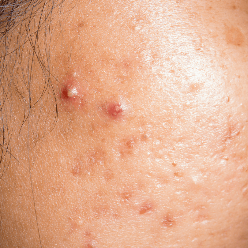 Understanding Acne: Types, Causes &amp; the Best Actives for Clearer Skin