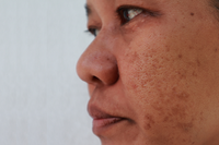 Dark Spots On Skin Causes, Prevention And Remedies