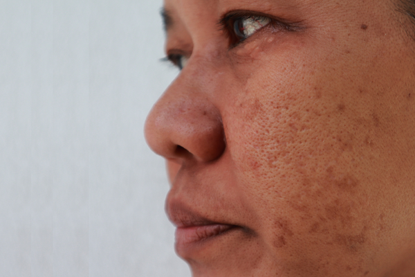Dark Spots On Skin Causes, Prevention And Remedies