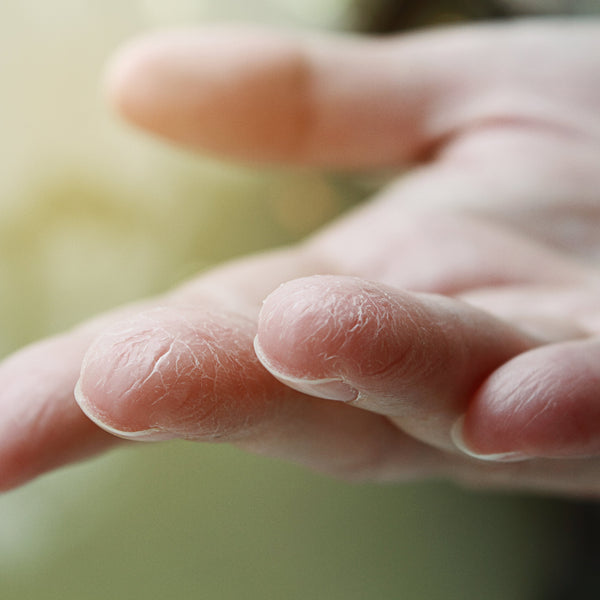 Cracked Skin: Causes And Remedies