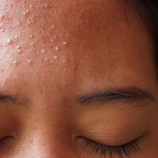 How to Get Rid of Pimples On Forehead? 11 Best Tips