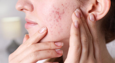 Fungal Acne in Monsoon: How to Identify, Treat, and Prevent It