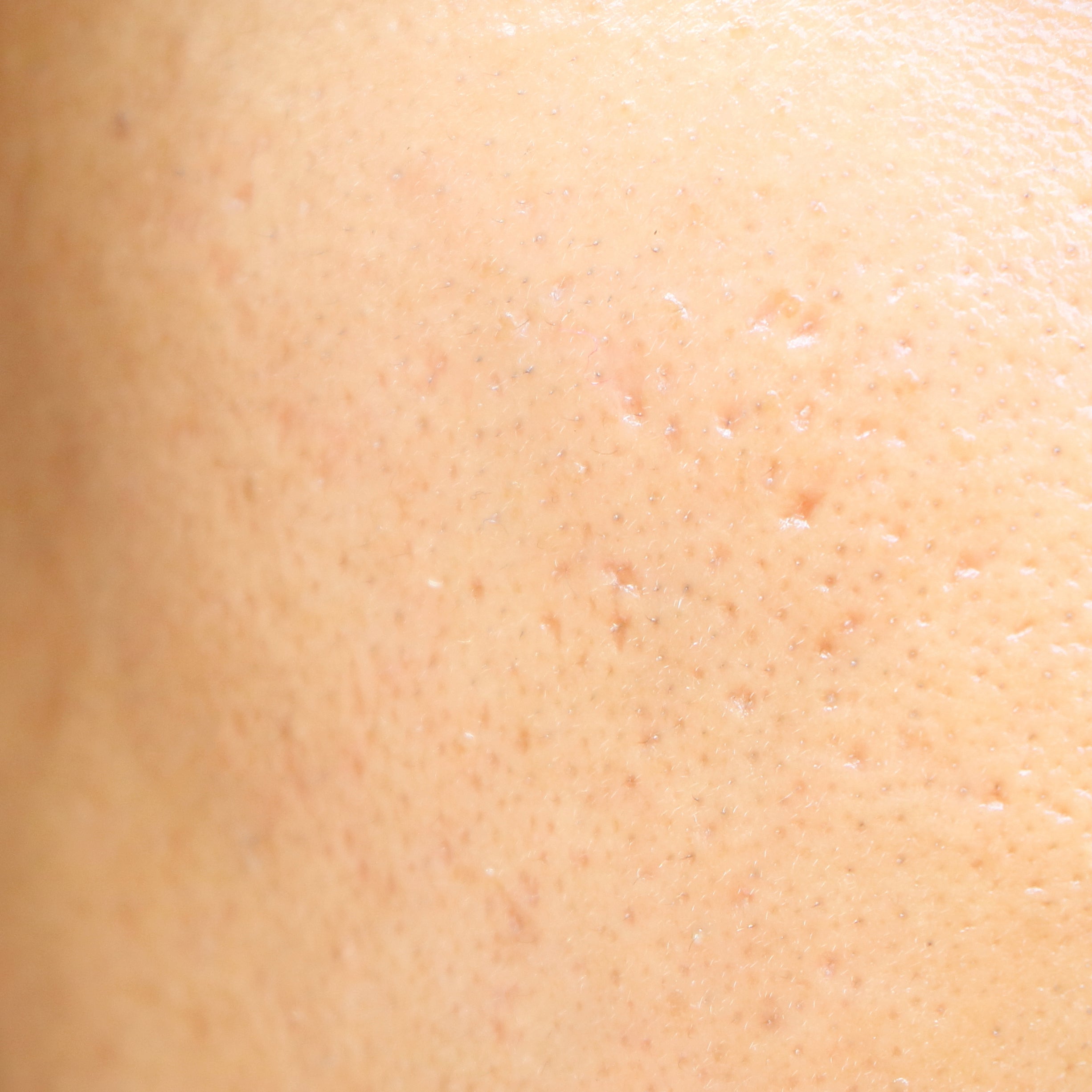 How To Get Rid Of Large Pores