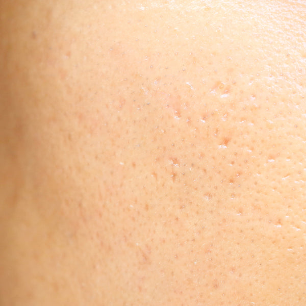 How To Get Rid Of Large Pores