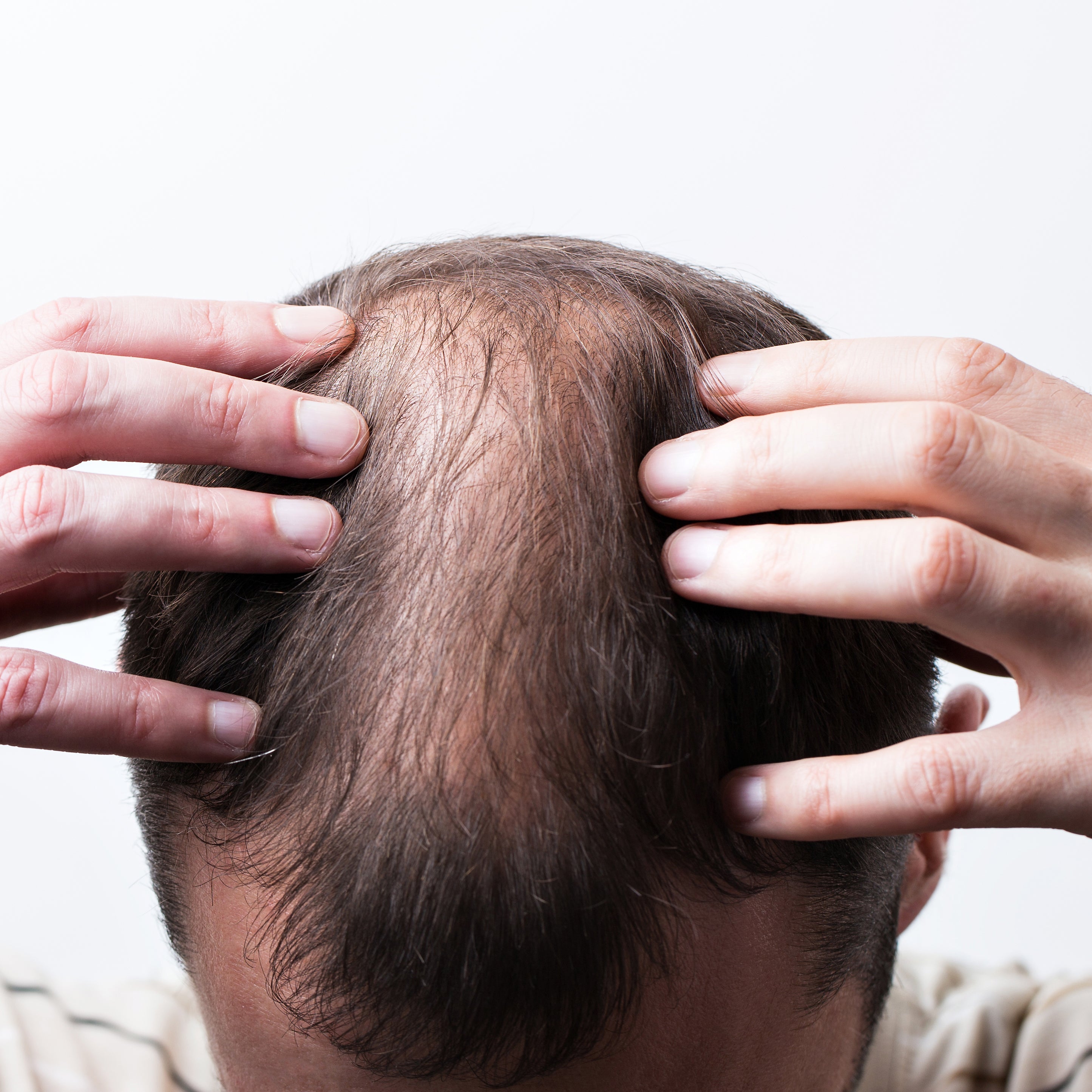 How to Regrow Hair Men 
