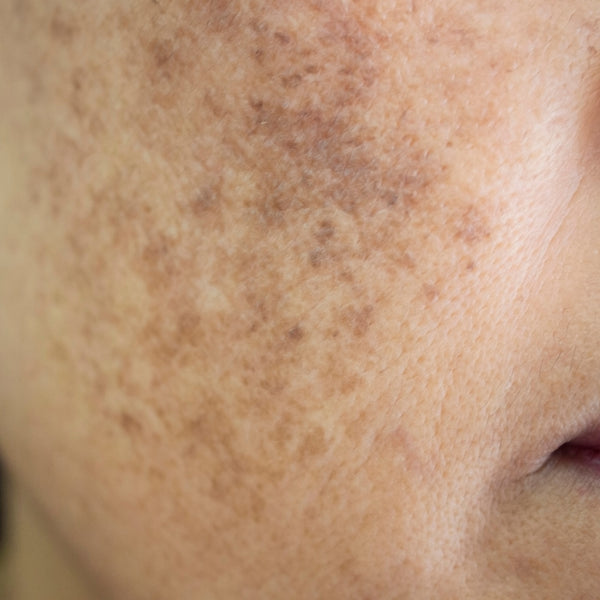 Hyperpigmentation Causes, Prevention And Remedies