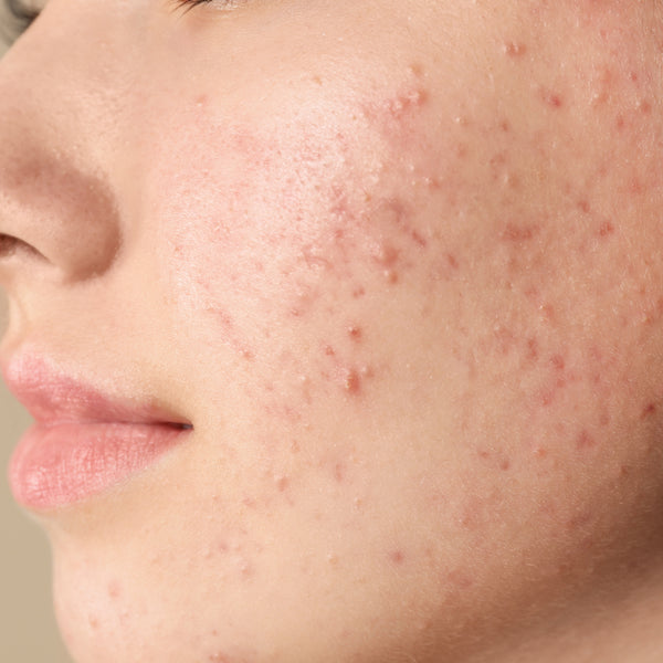 How To Remove Pimples And Pimple Marks?