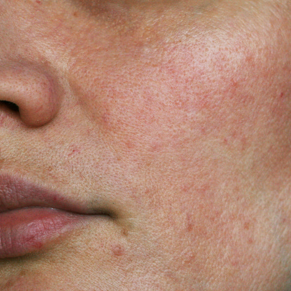 Looking to reduce Hyperpigmentation? Let Patience and Precaution prevail!
