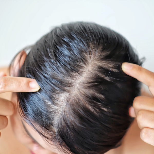Oily Hair: Causes, Prevention And Remedy