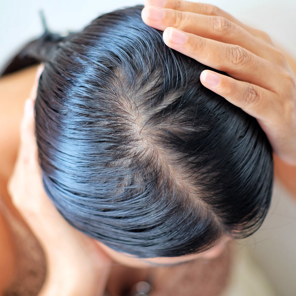 Best Home Remedies for Oily Scalp and Hair  PharmEasy Blog