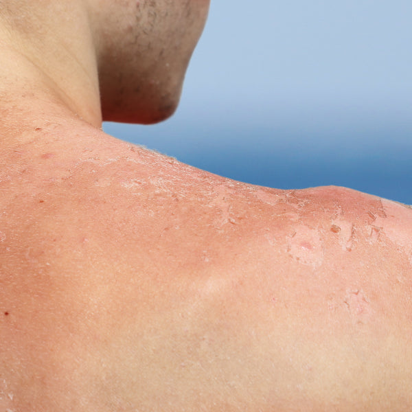 Photodamaged Skin: Causes And Remedies