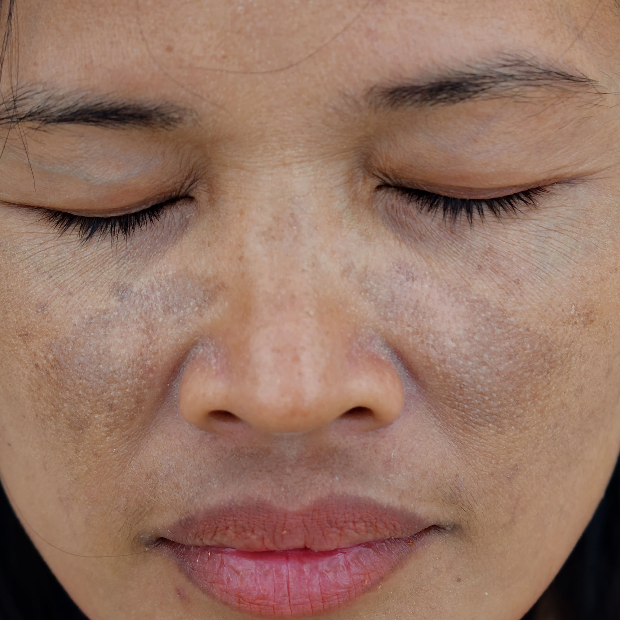 How to Remove Pigmentation Around Lips