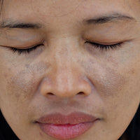 How to Remove Pigmentation Around Lips