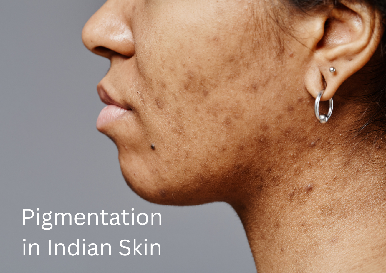 Pigmentation in Indian Skin: What Causes It & Which Ingredients Actually Work