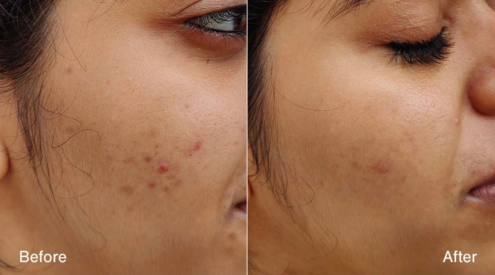 Post-Acne Marks vs Pigmentation: Understanding the Difference