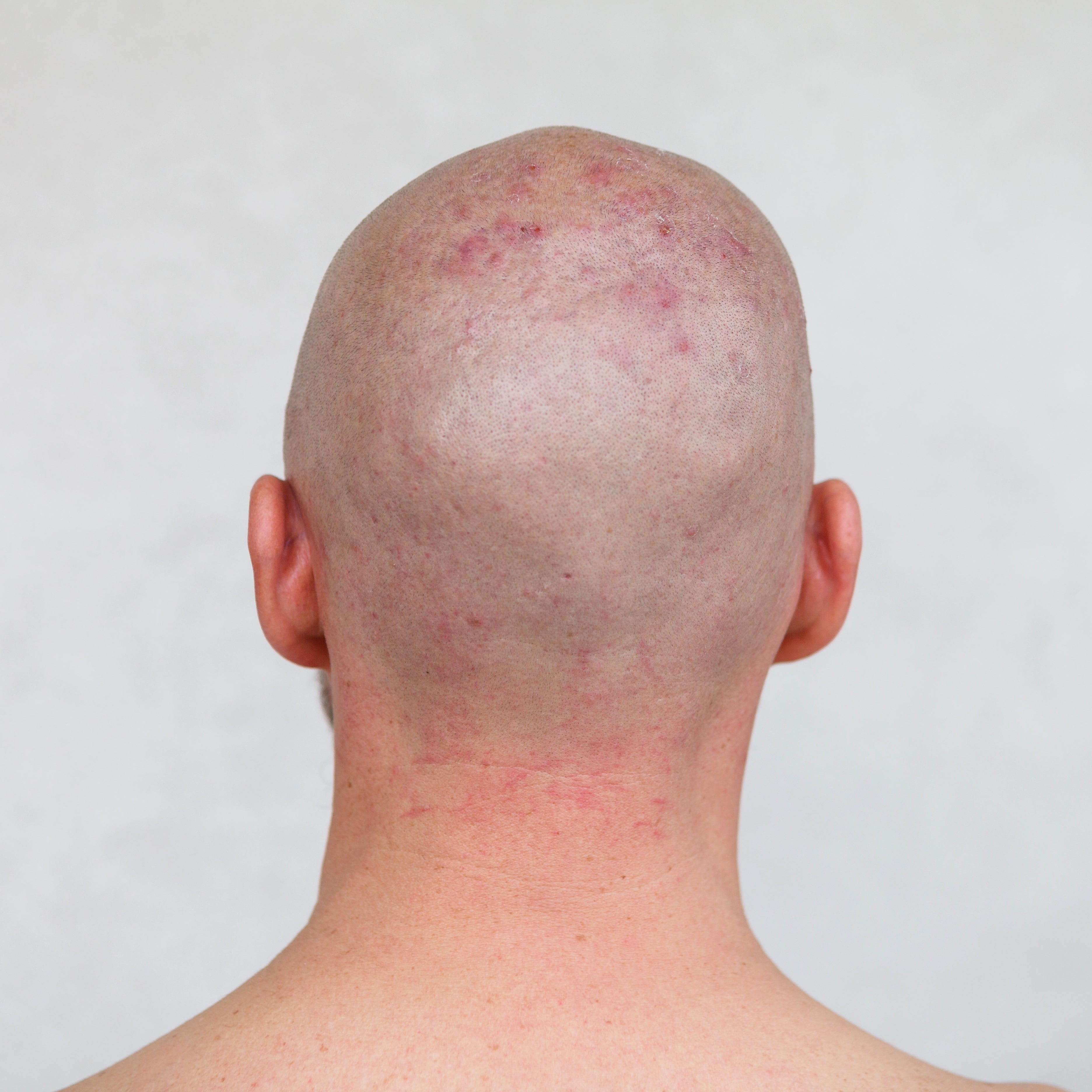 https://juicychemistry.com/cdn/shop/articles/Scalp_Acne_Causes_Prevention_And_remedy_shutterstock_1637432248_1by1.jpg?v=1640601785
