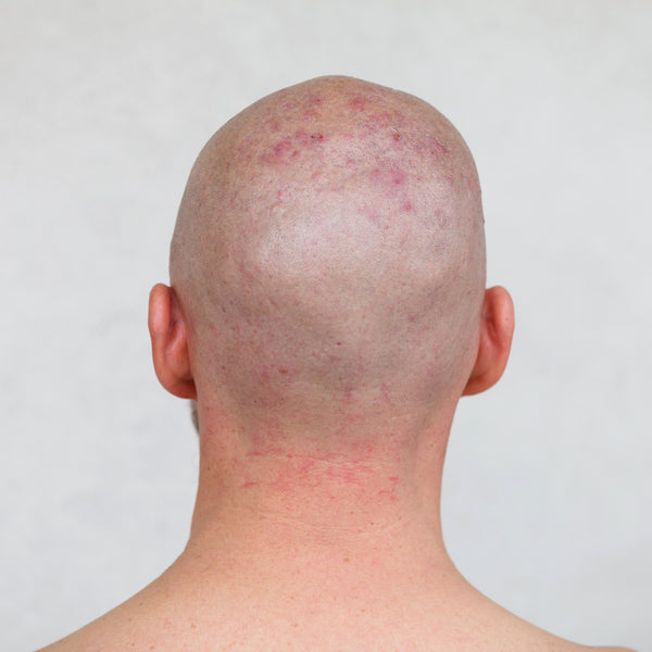 Scalp Acne: Causes, Prevention And remedy