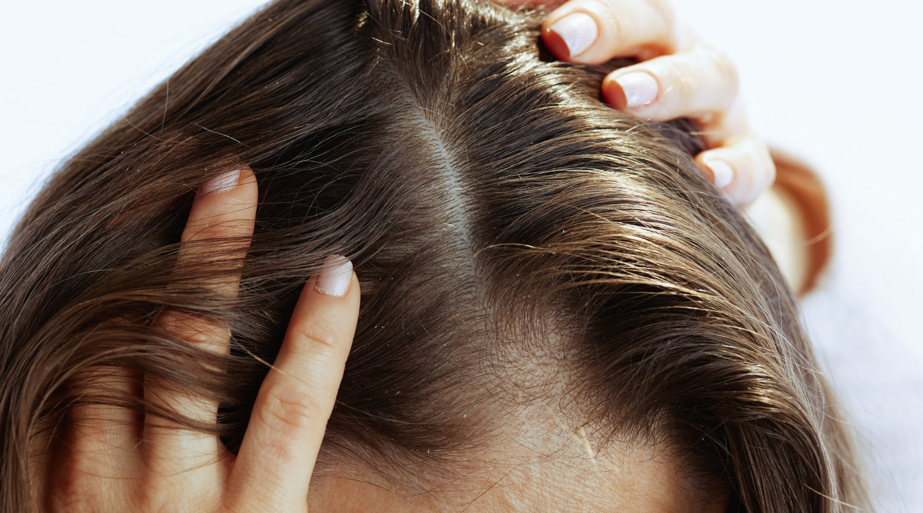 Scalp Fungal Infections in Monsoon: Signs, Causes, and Natural Treatment