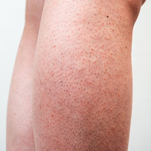 How to get rid of Strawberry Legs