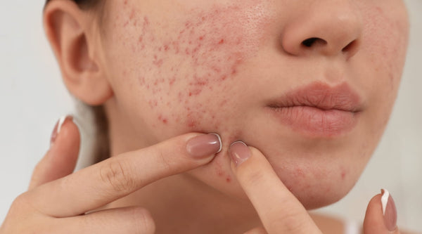 What Ingredients to Look for In a Face Wash for Oily and Acne-Prone Skin?