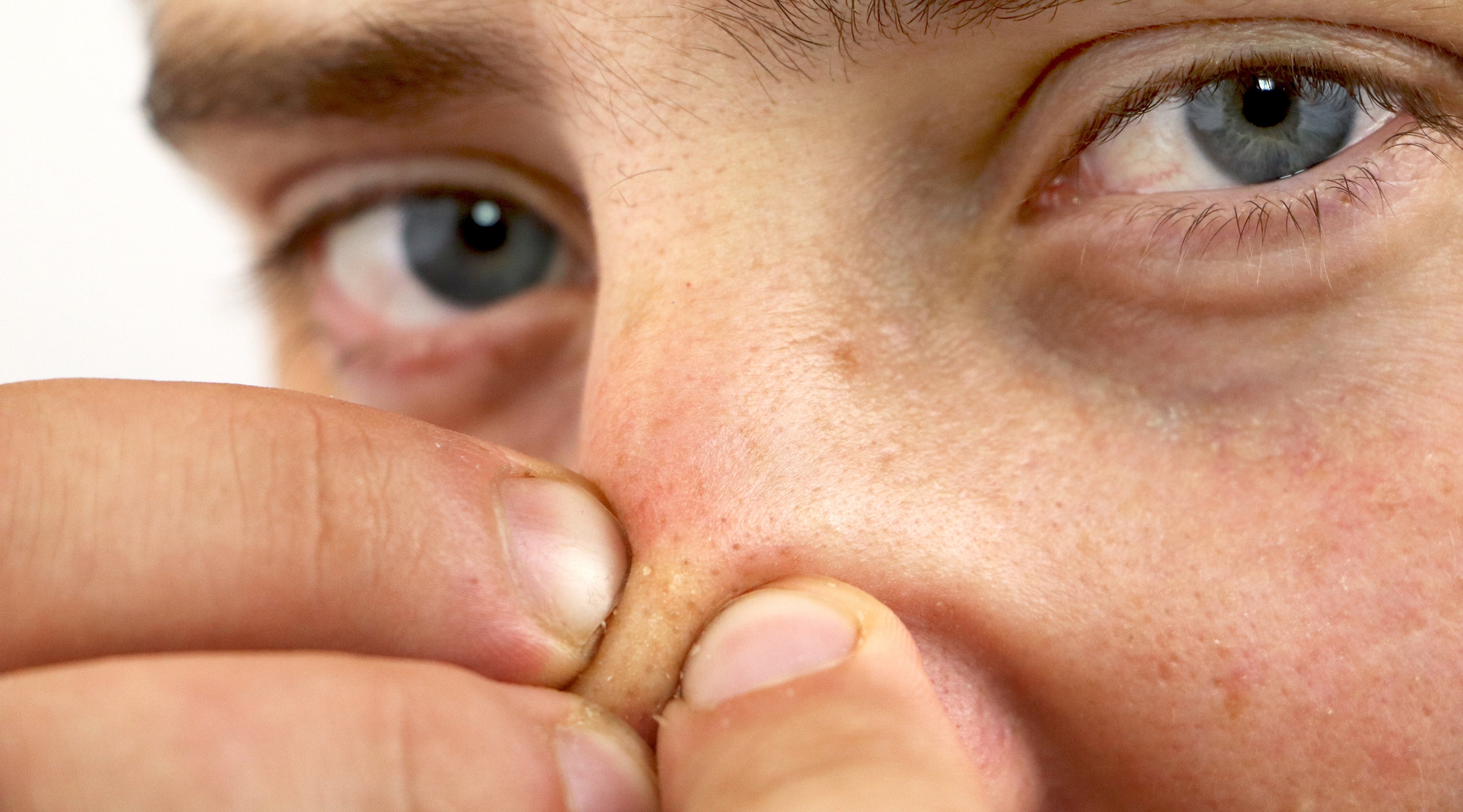 Whiteheads vs Blackheads: What Causes Them and How to Clear Them Naturally