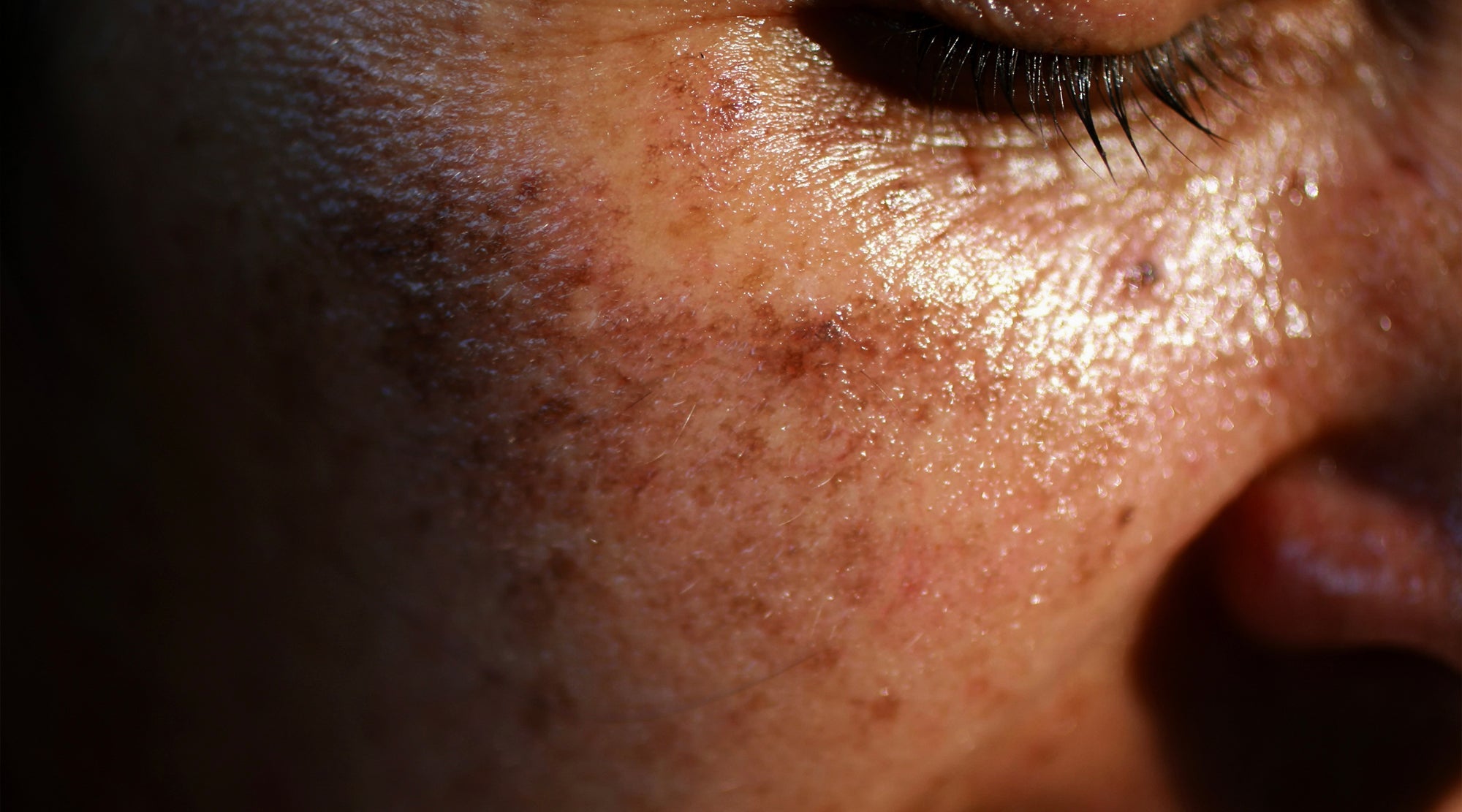Why Pigmentation Is More Common in Indian Skin