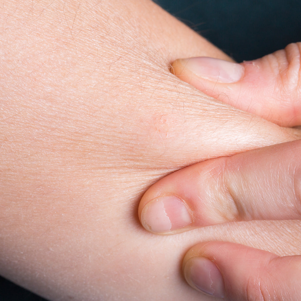 Dry Skin - Dr Qaisar Ahmed