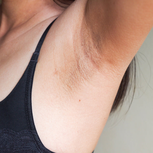 How to lighten underarm Pigmentation Naturally?