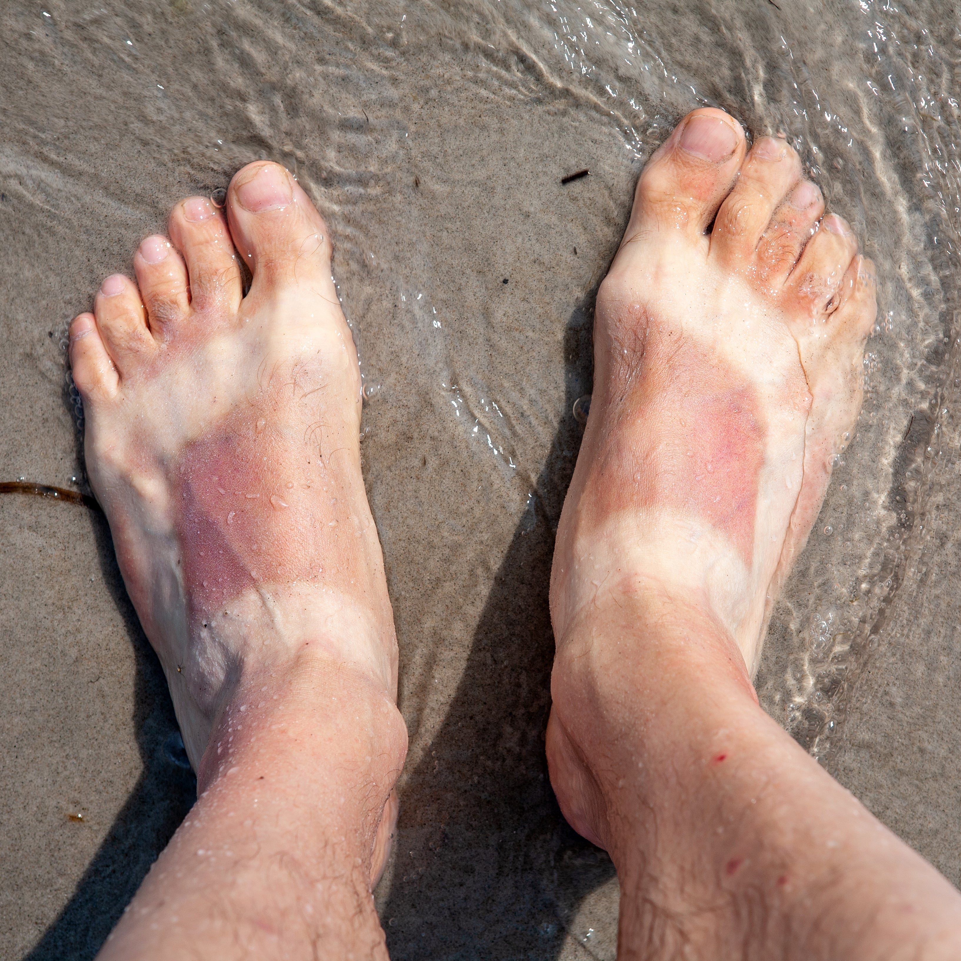 How to remove tan naturally, home remedies for tan removal