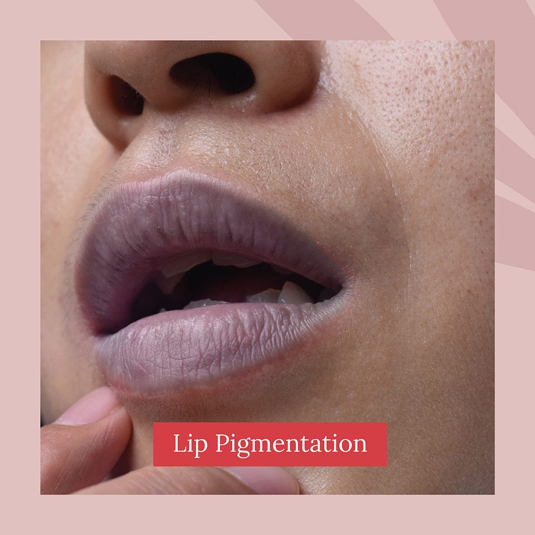 files/LipPigmentation.jpg