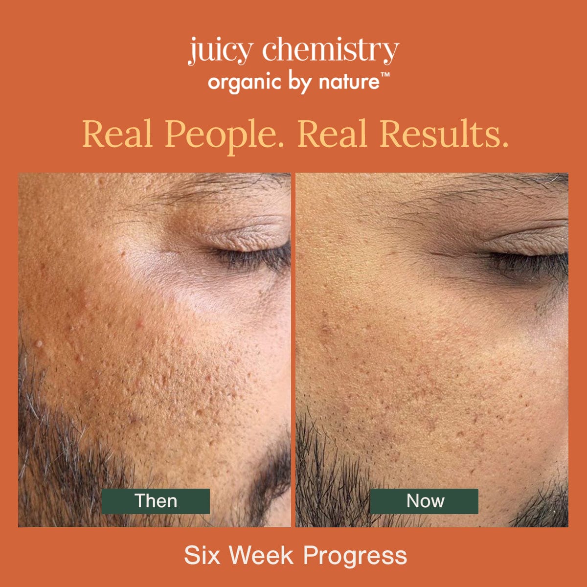 Organic and Naturally Activated Anti Acne Kit - Customer Result progress