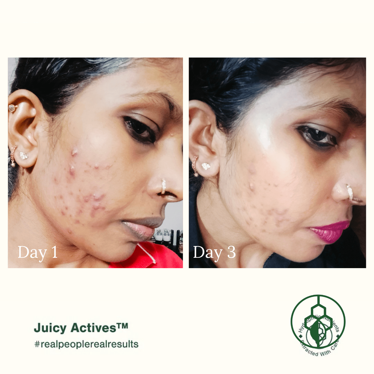 Organic and Naturally Activated Anti Acne Kit - Customer Result